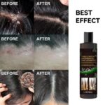 Scalp Flakes Antipruritic Hair Shampoo results