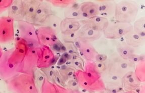 American Cancer Society recommends self-swab HPV test for cervical cancer screening