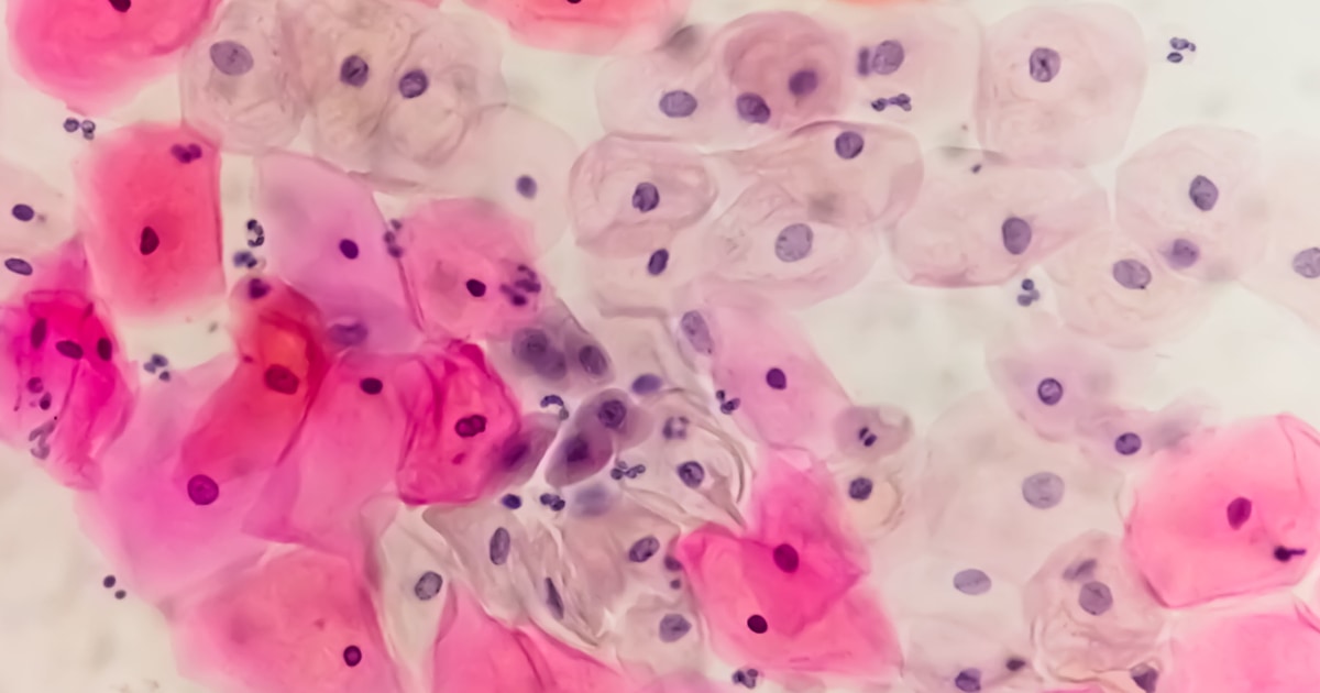 American Cancer Society recommends self-swab HPV test for cervical cancer screening