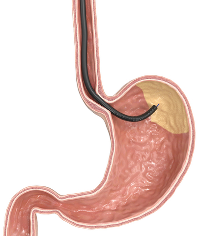 setting new standards in endoscopic bariatric treatment